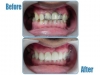 Zirconia bridge in front teeth