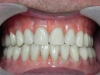 Implant Supported Dentures with Cancun Dentist