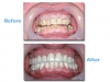 Affordable Cosmetic dentistry from Mexico dental