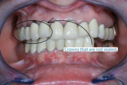 loose root canal crown