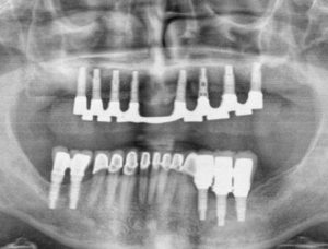 mouth reconstruction nucleo dental juarez mexico