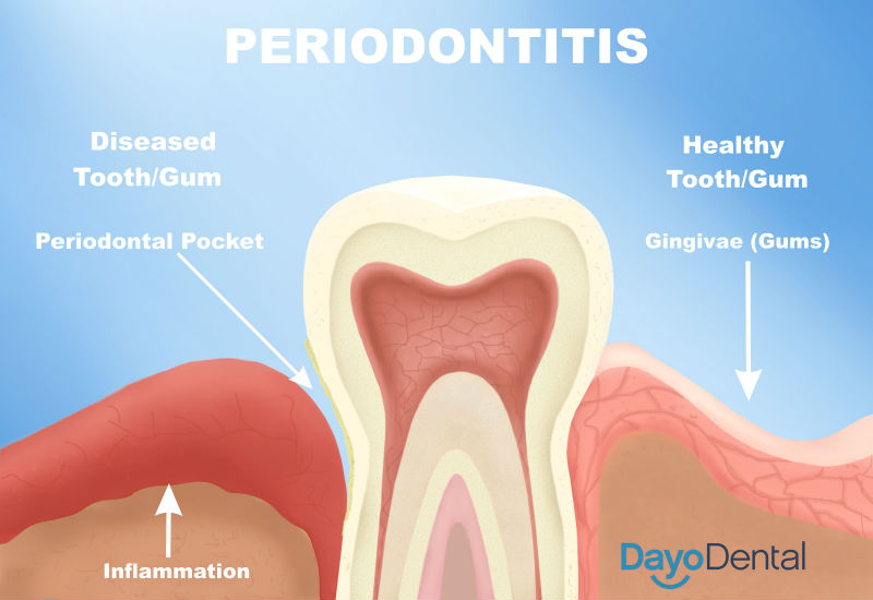 Parodontitis - Gesundes gegen schlechtes Zahnfleisch
