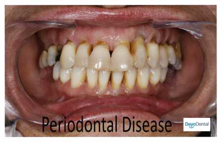 Modified Periodontal Disease Opt 2 