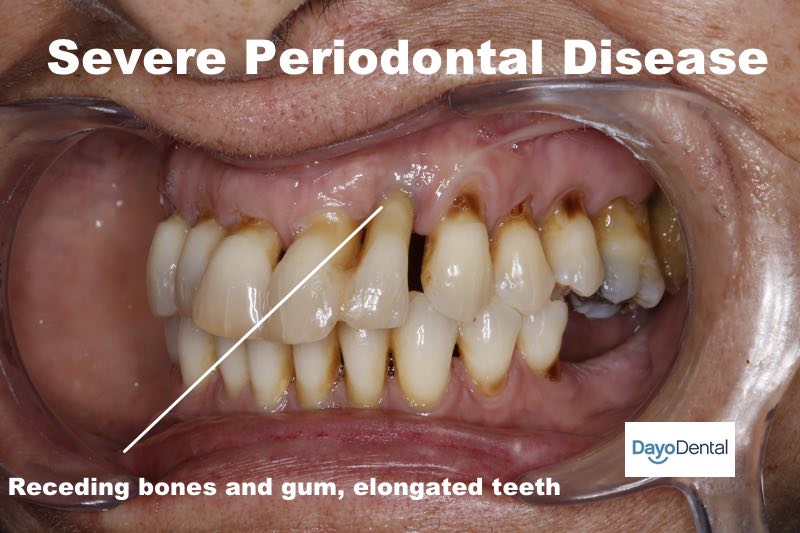 súlyos parodontális betegség, előrehaladott peridontitis